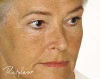 cheek enhancement